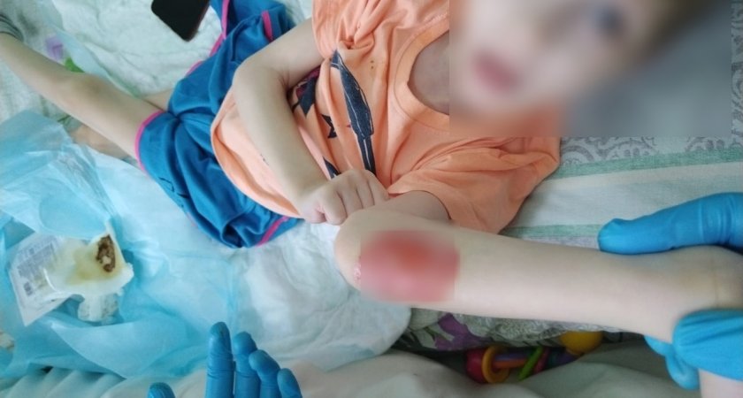 "Вся рука была обуглена": в сыктывкарской больнице 7-летняя девочка получила ожог 