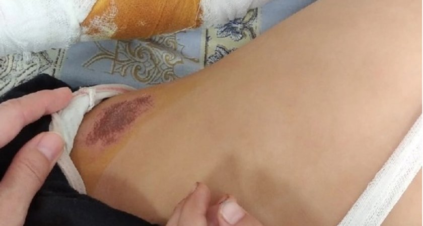 "Я услышал детский крик": выяснились подробности нападения собаки на девочку в Ухте