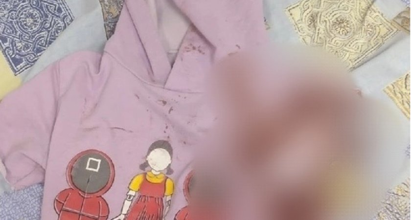 Девочка, которую покусала собака в Ухте, пошла на поправку