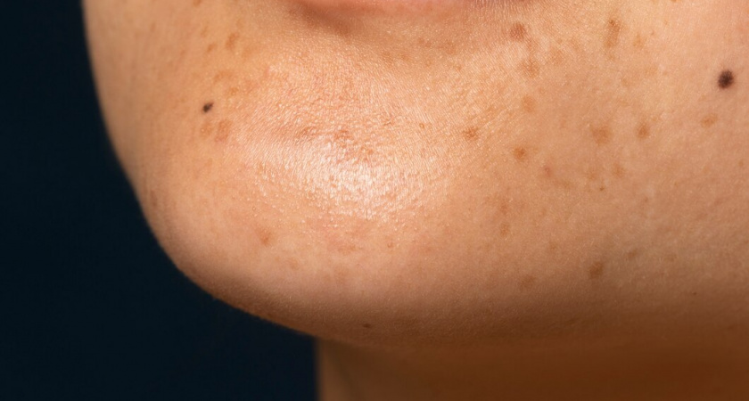 Четыре простых способа избавиться от пигментных пятен на лице и теле: советы профессионального косметолога