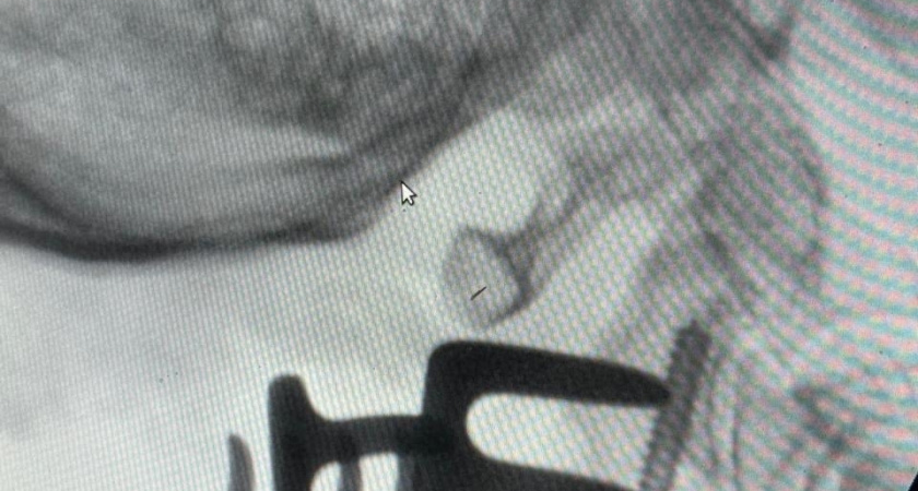 Сыктывкарские нейрохирурги успешно выполнили первую в Коми операцию при переломе второго шейного позвонка