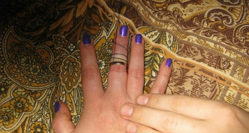 Сыктывкарцам рассказали, как снять кольцо с опухшего пальца