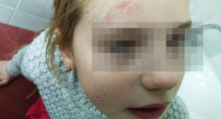 В Коми два школьника жестоко избили девочку и попытались ее поджечь