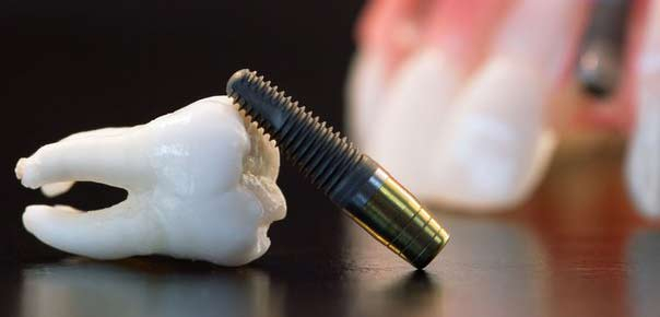 Как восполнить утрату… зуба?