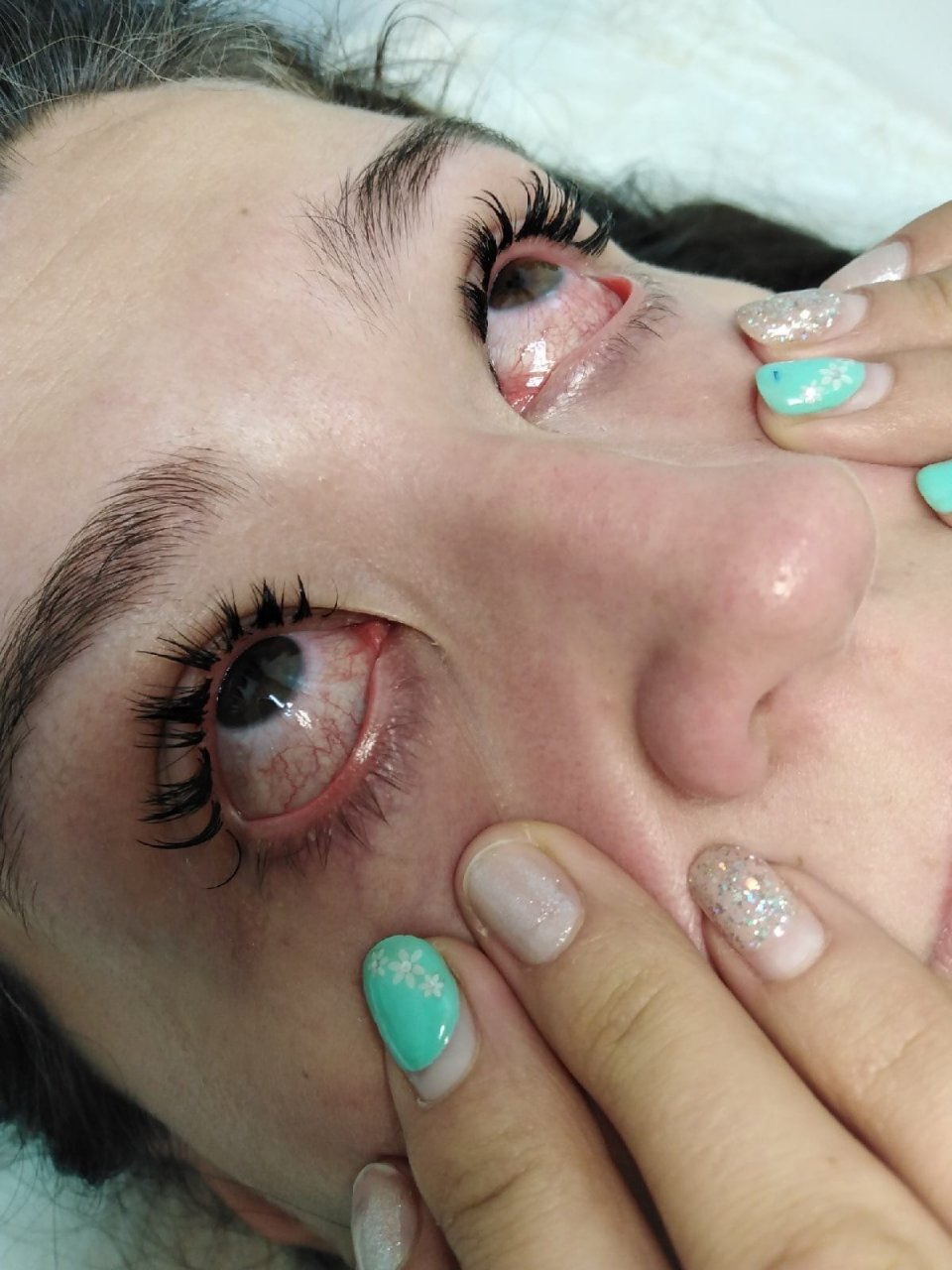 Сыктывкарке выжгли глаза во время косметической процедуры