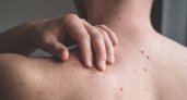 Онколог рассказала, какие родинки можно удалять