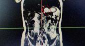 В Сыктывкаре благодаря диспансеризации у семилетней девочки обнаружили удвоение желудка
