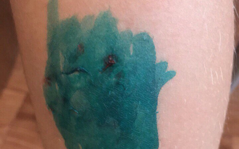 В Коми собаки покусали 6-летнюю девочку (фото)