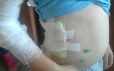 В Коми собака серьезно покусала пятилетнего малыша (фото)