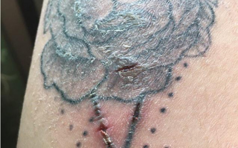 У жительницы Коми после визита в тату-салон начала гноиться рука (фото)