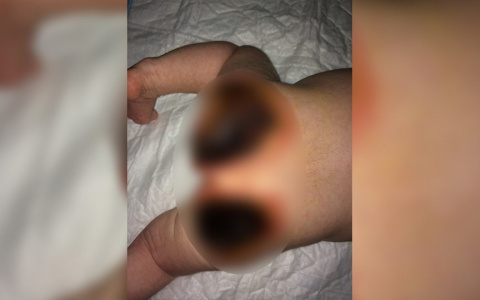 Медсестра больницы оставила новорожденной девочке сильнейшие ожоги (фото)