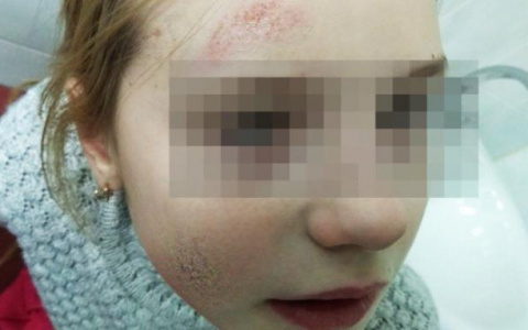 В Коми два школьника жестоко избили девочку и попытались ее поджечь