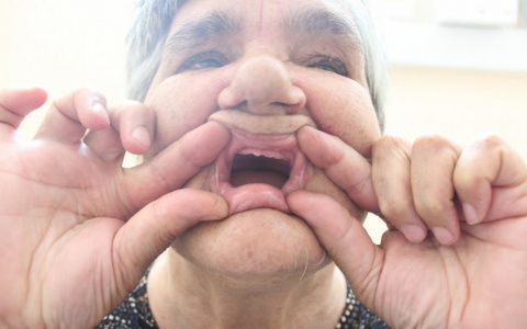 Сыктывкарка 13 лет живет без единого зуба (фото)