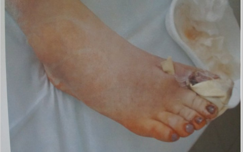 Сыктывкарка утверждает, что из-за ошибки хирургов она лишилась пальца (фото 16+)