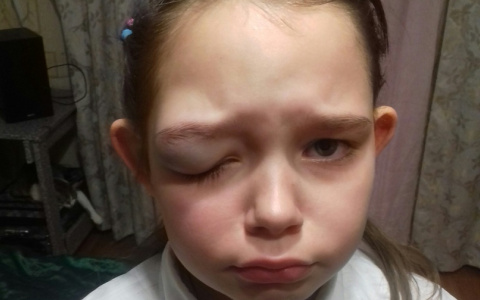 В сыктывкарской школе 9-летняя девочка получила отек глаза
