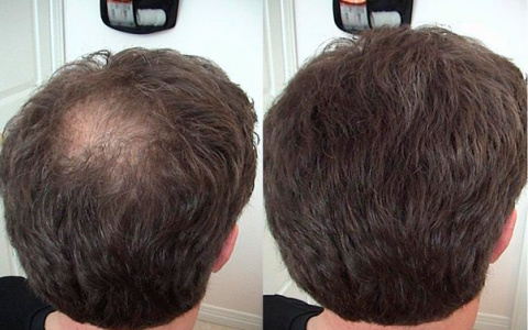 Как гены могут сохранить роскошные волосы надолго?