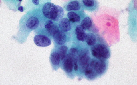 Ученые создали искусственные клетки, которые лечат рак