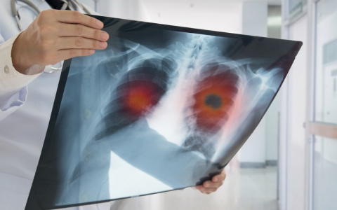 Медики рассказали, почему не могут обнаружить рак вовремя