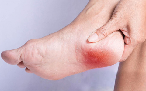 Пяточная шпора: почему возникает боль? (видео)