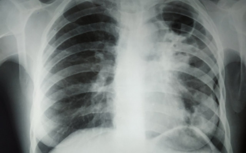 Названы способы восстановить легкие после COVID-19