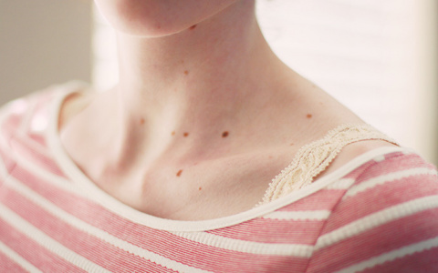 Врач рассказала, чем грозят красные родинки
