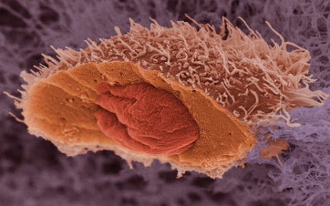 Ученые раскрыли способ предотвращения последней стадии рака
