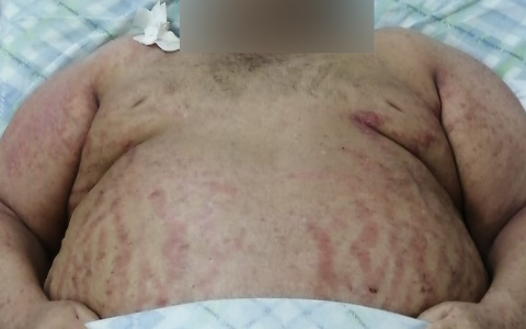 180-килограммовый сыктывкарец сломал позвоночник и просит помощи