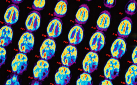 Врач назвал признак возможной опухоли мозга