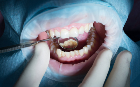 «Легкие» проблемы с зубами, которые могут привести к серьезным последствиям: разбор полетов с сыктывкарским стоматологом