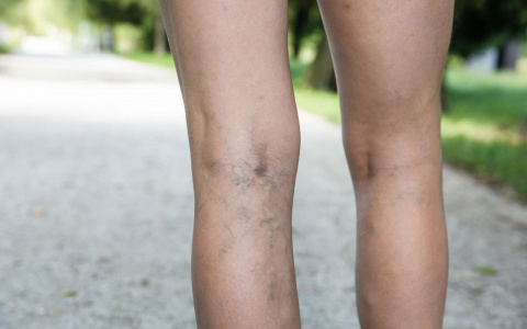 В Клинике КГМУ жителям Коми лечат варикоз по полису ОМС