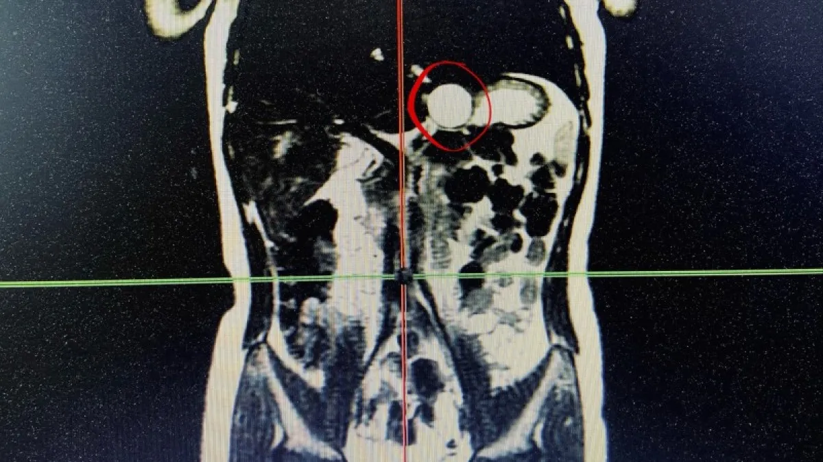 В Сыктывкаре благодаря диспансеризации у семилетней девочки обнаружили удвоение желудка