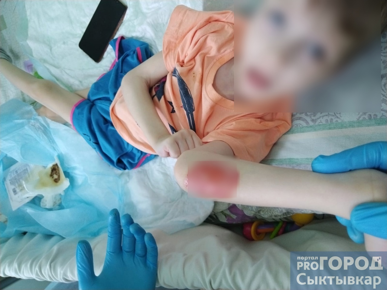 "Вся рука была обуглена": в сыктывкарской больнице 7-летняя девочка получила ожог 