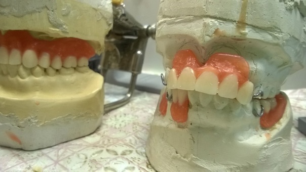Сыктывкарка вернула стоимость некачественного протезирования зубов
